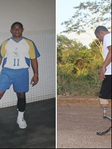 Superado o susto, Wesley começa adaptação com perna mecânica após trauma do acidente.(Imagem:Emanuele Madeira)