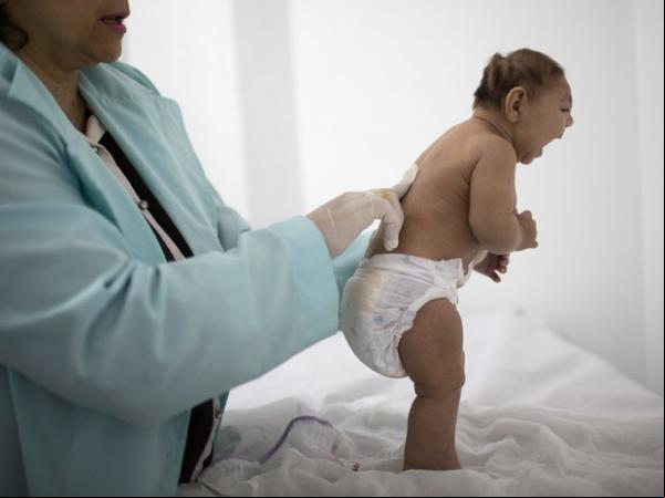 Bebê com menos de 3 meses que nasceu com microcefalia é examinado por neurologista.(Imagem:Felipe Dana/AP)