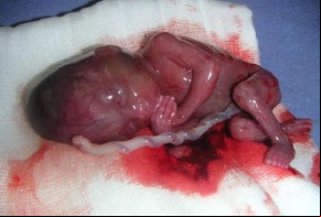 Projeto de lei prevê aumento de pena para aborto em caso de microcefalia.(Imagem:Divulgação)