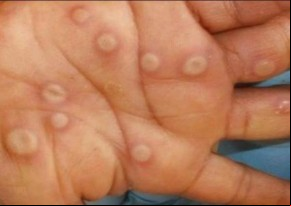 Sobe para 18 os casos confirmados de varíola dos macacos no Piauí(Imagem:Divulgação)