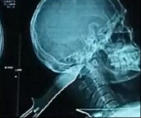 Homem leva facada na cabeça, mas consegue dirigir e pedir ajuda.(Imagem:Galileu)