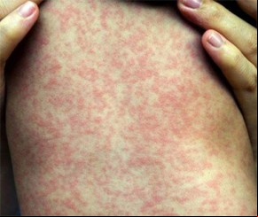 Casos de sarampo avançam e chegam a 4.507 em 90 dias.(Imagem:Divulgação)