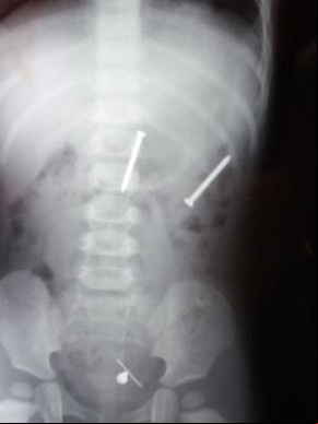 Radiografia do corpo da menina.(Imagem: Europics)