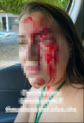 Jovem usa rede social para denunciar agressão que sofreu do namorado, em Teresina.(Imagem:Instagram/ Reprodução)
