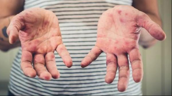 Facilmente evitada por vacina, o sarampo voltou com força no Brasil a partir de 2018.(Imagem:Getty Images via BBC)