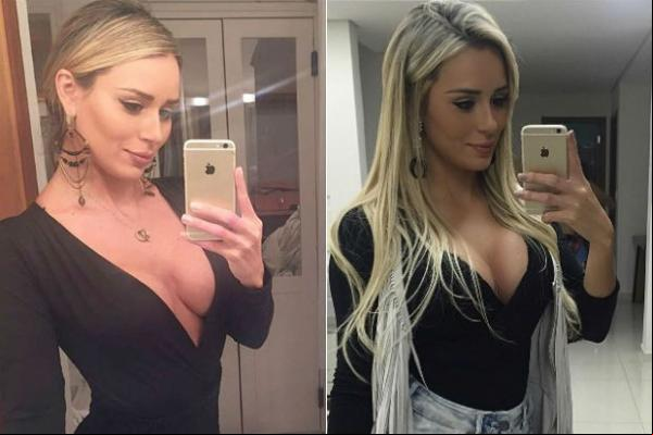 Leticia Santiago antes e depois de trocas as próteses de silicone: