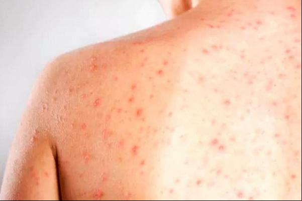 Sarampo: baixa cobertura vacinal preocupa autoridades de saúde(Imagem:Divulgação)