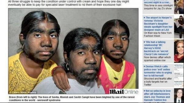 As indianas têm a síndrome do lobisomem.(Imagem:Reprodução / Daily Mail )