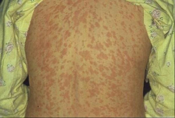 Manchas vermelhas pelo corpo podem aparecer em pessoas que contraíram sarampo.(Imagem:Divulgação/Sesa-ES)
