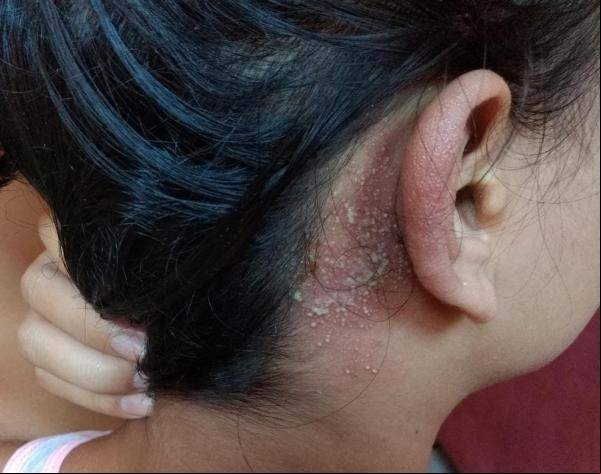 Estudante foi vítima do potó enquanto dormia.(Imagem:Arquivo pessoal)