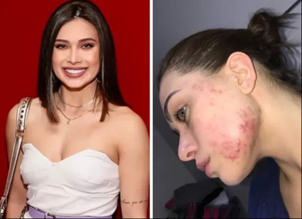 Flavia Pavanelli relembra crise acneica. (Imagem:Reprodução/Instagram )