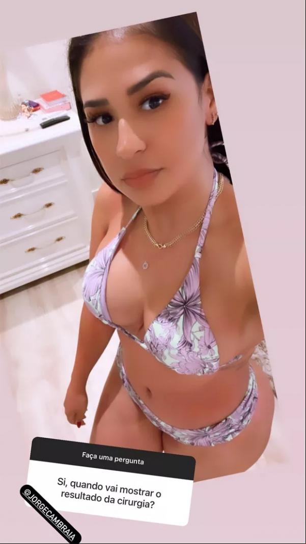 Simone posa de biquíni para mostrar o corpo após abdominoplastia e emagrecimento.(Imagem:Reprodução / Instagram)
