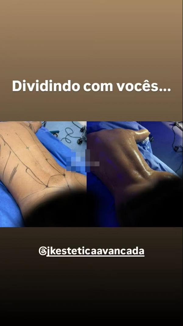 Antes e depois da lipo LAD de Lívia Andrade.(Imagem:Reprodução/Instagram)