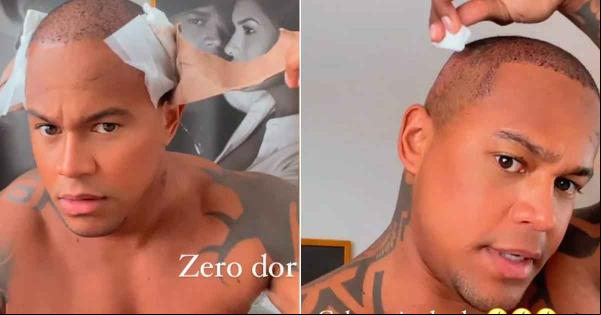 Leo Santana a por novo implante capilar(Imagem:Reprodução)