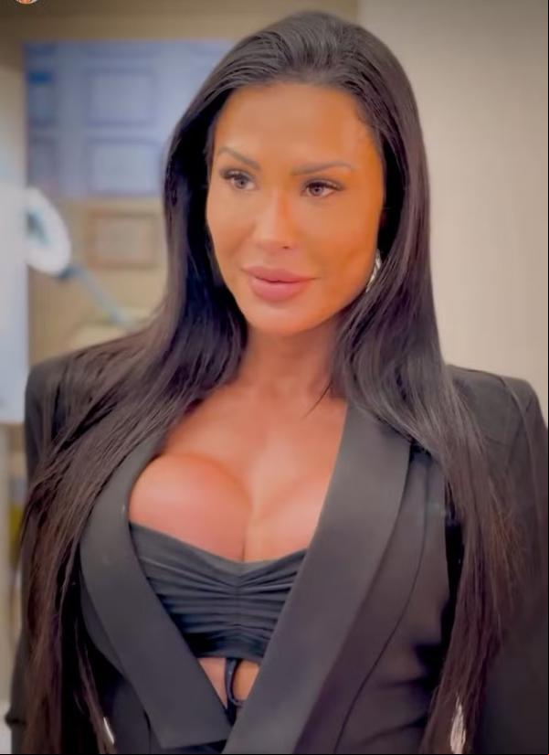 Gracyanne Barbosa mostra resultado da remoção de preenchimentos faciais.(Imagem:Reprodução/Instagram)