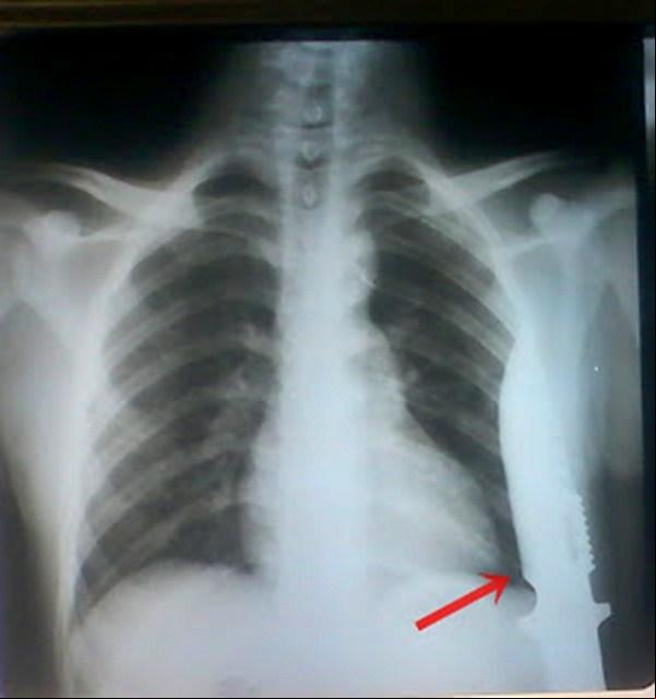 Radiografia de Marcelo (Imagem:blog do Yuri Junior)