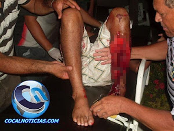 Colisão de moto com trator deixa motoqueiro e garupeiro com fraturas expostas nas pernas.(Imagem:Blog Cocal Notícias )