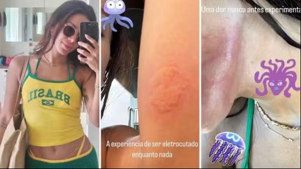 Anitta sofre queimadura por água-viva em Ibiza e relata maior dor da vida.(Imagem:Reprodução/Instagram)